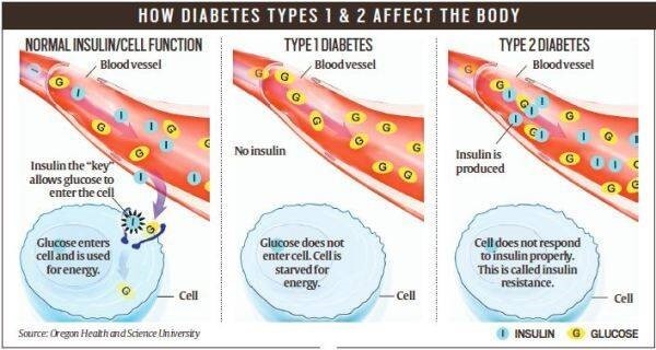 Diabetes-types