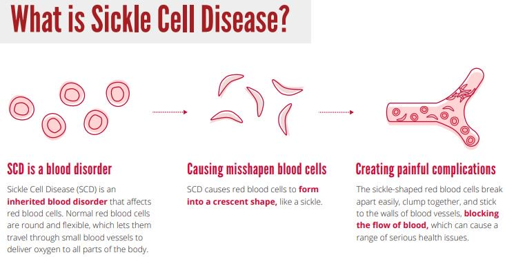 World Sickle Cell Disease Day 2021